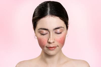 Woman with Rosacea condition