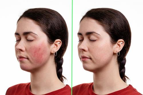 Rosacea reduction results after VBeam laser therapy
