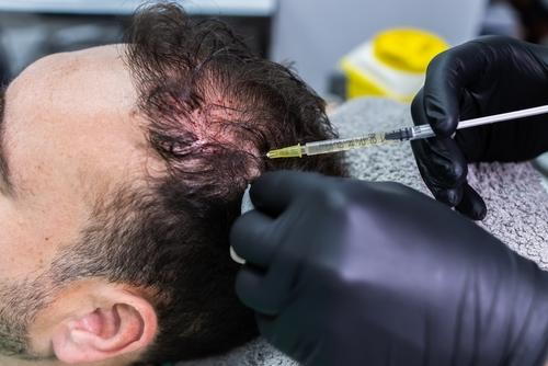 Patient receiving PRP injection for hair loss