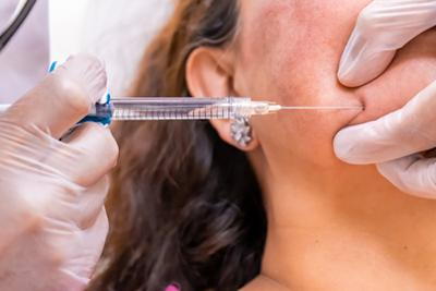 Illustration of Juvederm procedure