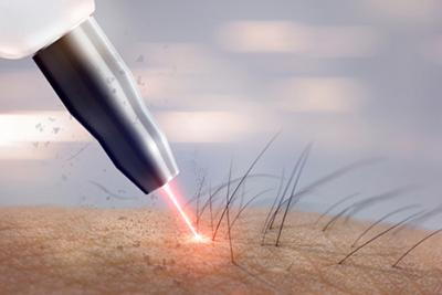 Illustration of how Laser Hair Removal Treatment do