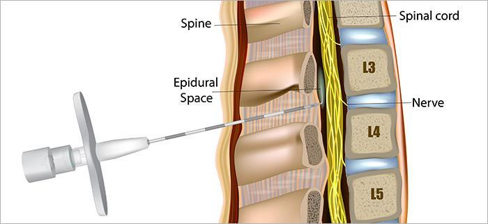 spinal stenosis injections