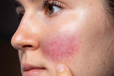 Rosacea skin condition in a face of a woman