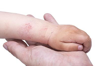 Closed-up-image-of-child-rashes-in-hand.