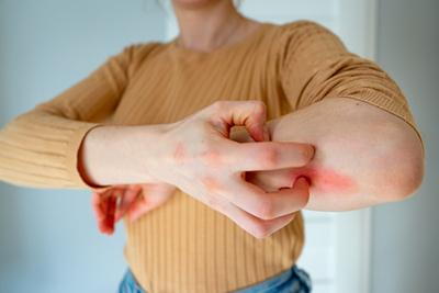 Woman suffering in rashes in arms with redness.