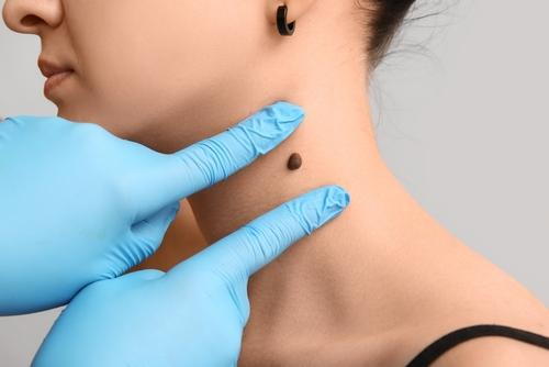 Dermatologist examining a patient’s mole for changes or abnormalities