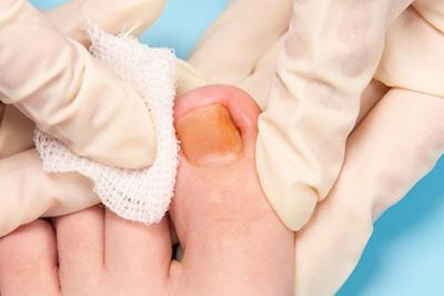 Foot-Doctor-Holding-Patient's-Ingrown-Toenail