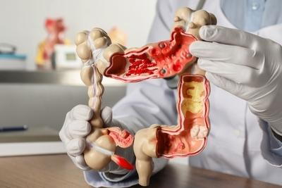 Model of colon with cyst hold by the doctor