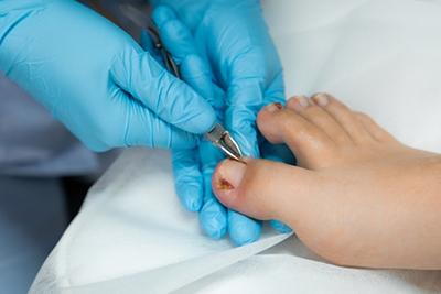 Close-up of foot specialist performing ingrown nail procedure.