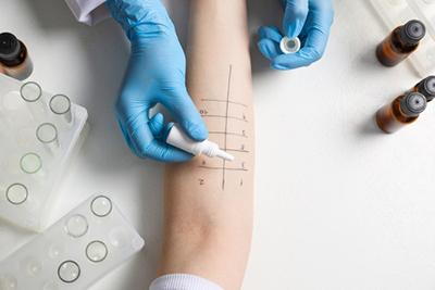 Skin-Allergy-Test-Procedure-with-Prick-Method