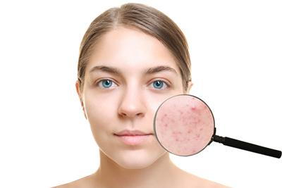 What To Expect During Acne Treatment