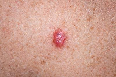 Basal cell carcinoma