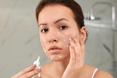 Woman-Treating-Her-Acne