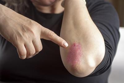 Psoriasis-in-Arm-of-a-Middle-age-Woman