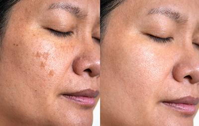 Skin improvement after sun spot treatment