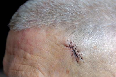 Illustration of MOHS after Surgery