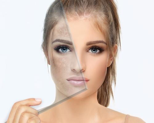 Woman before and after hyperpigmentation treatment