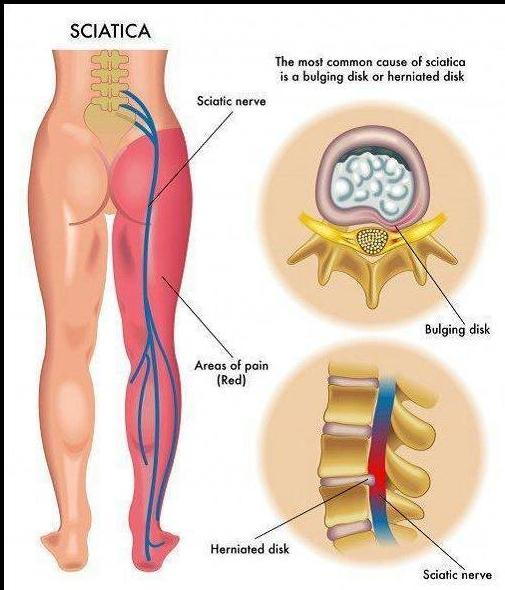 Natural Remedies For Your Sciatica Pain