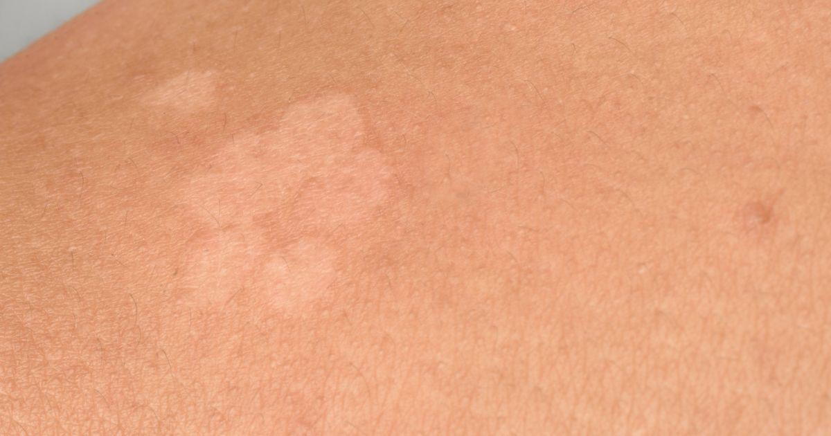 Skin Fungus | Natura Dermatology