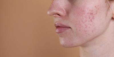 Patient-with-Acne-Problem