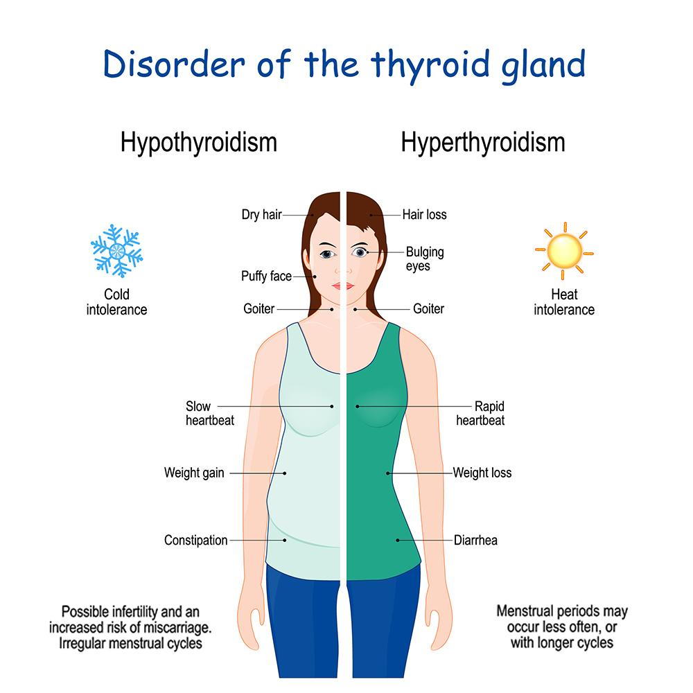 Medical illustration comparing symptoms of hyperthyroidism and hypothyroidism