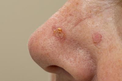 Illustration of Precancerous Skin Growths