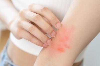 Woman itching her arms with redness.