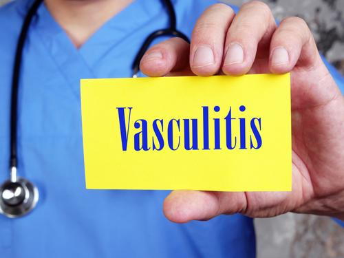Doctor holding a paper with vasculitis written on it