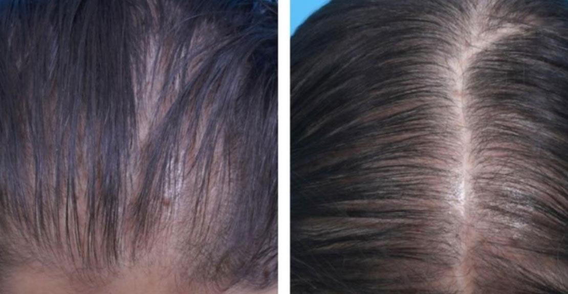 Female Hair Loss and Restoration with Dr. Ward
