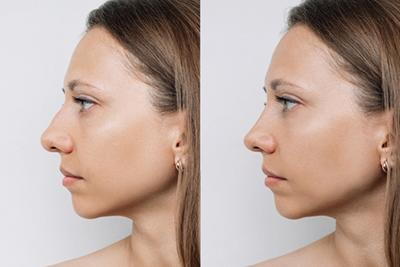 Nose-Job-Presurgery-and-Postsurgery