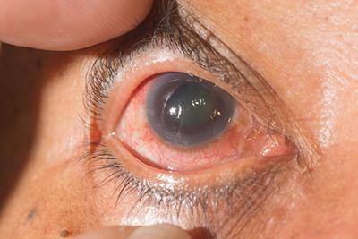 Close-up view of human eye affected by glaucoma