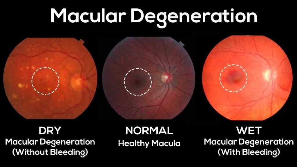 Dry Vs Wet Macular Degeneration   Heroimage0.730454001582763948 