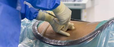 Illustration-of-Epidural-Steroid-Injections-at-the-spine