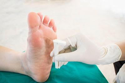 Close-up of podiatrist conducting a foot sensitivity test for diabetic neuropathy.