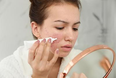 Teen-Woman-with-Acne-Problem-Looking-at-the-Mirror