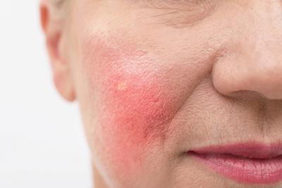 Rosacea-Skin-Condition-on-Old-Woman's-Face