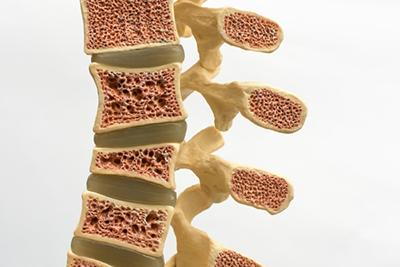 Bone-Loss-Density-Due-to-Osteoporosis