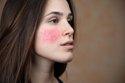 Woman with Rosacea condition in face with redness.
