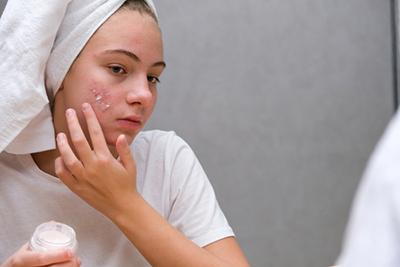 Woman using topical cream for acne treatment