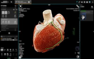 Medical concept showing 3D heart scan by Cleerly for heart health assessment.