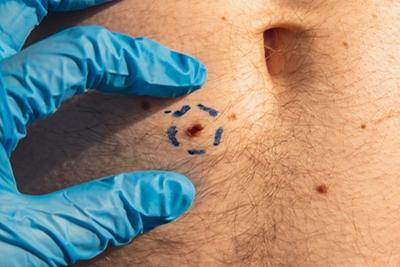 Skin-Tag-Removal-Concept