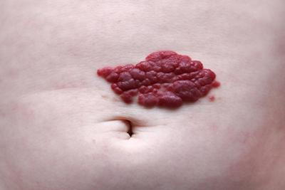 Hemangioma-a-Type-of-Skin-Lesion