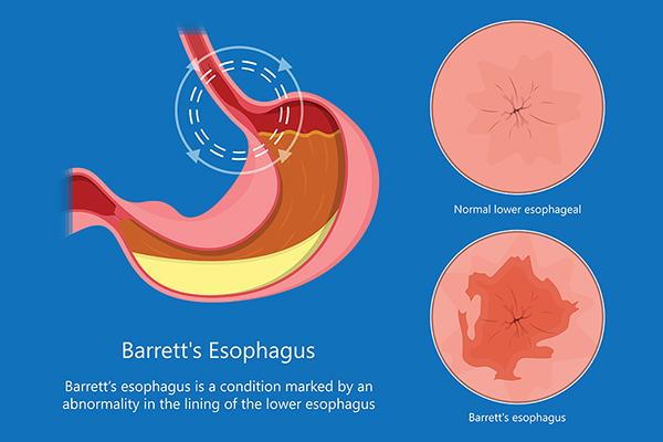 Barretts-Esophagus-Illustration