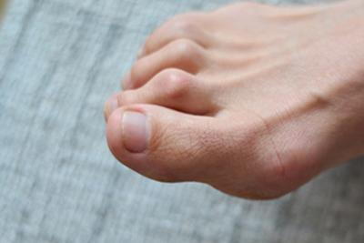 Hammertoes condition on a persons foot