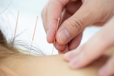Acupuncture-Treatment-for-Neck-Pain