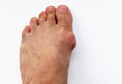 Person-with-Bunion-condition-with-white-background.