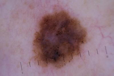 Close-up-Picture-of-Melanoma