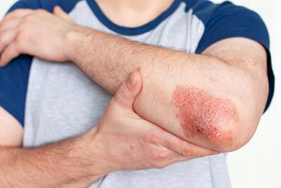 Man with Psoriasis in arms.