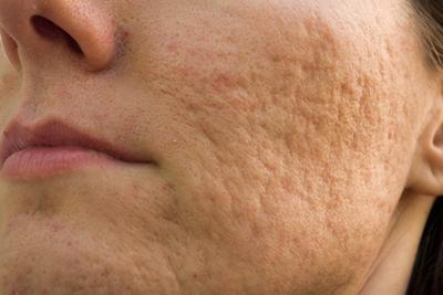 Acne Scars on face of a woman