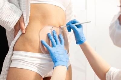 Marking the abdomen before CoolSculpting with the doctor.
